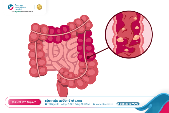 POLYP ĐẠI TRÀNG – “KHỐI U THẦM LẶNG” NHƯNG CÓ THỂ PHÒNG NGỪA ĐƯỢC UNG THƯ