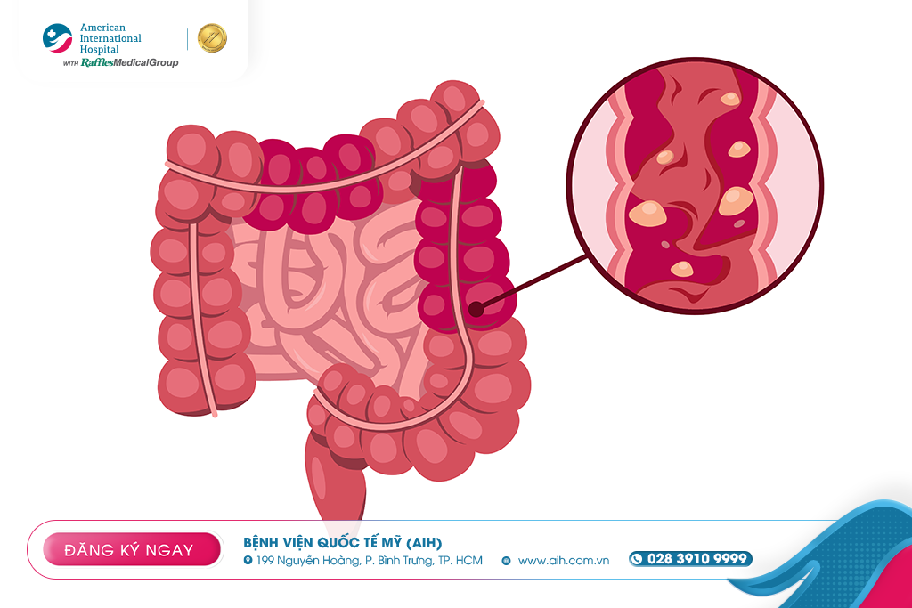 COLON POLYPS – THE “SILENT TUMORS” THAT CAN PREVENT CANCER