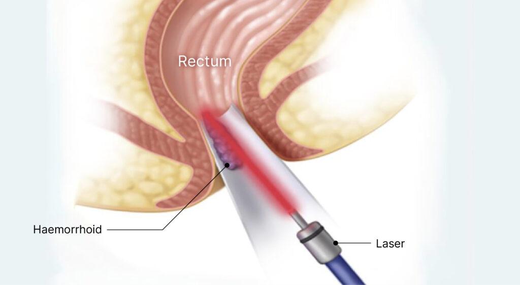 aelius-website-haemorrhoid-laser-treatment-02-1024x561.jpg