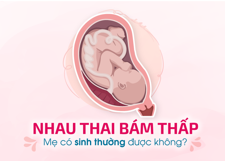 NHAU THAI BÁM THẤP – MẸ CÓ SINH THƯỜNG ĐƯỢC KHÔNG?