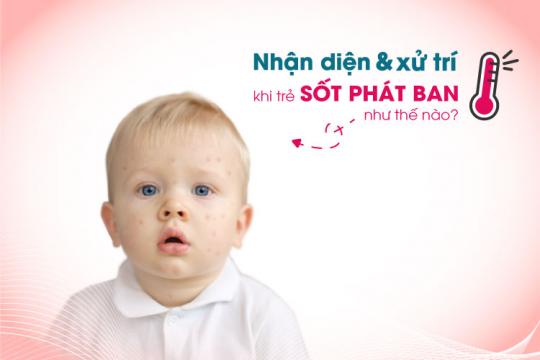 NHẬN DIỆN VÀ XỬ TRÍ KHI TRẺ SỐT PHÁT BAN NHƯ THẾ NÀO?