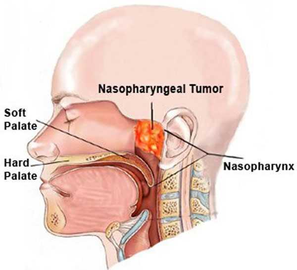 nasopharyngeal-cancer