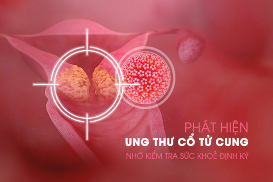 PHÁT HIỆN UNG THƯ CỔ TỬ CUNG NHỜ KIỂM TRA SỨC KHOẺ ĐỊNH KỲ VÀ CẮT BỎ KHỐI U KỊP THỜI TẠI BỆNH VIỆN QUỐC TẾ MỸ (AIH)